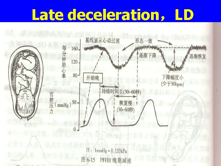 Late deceleration，LD 