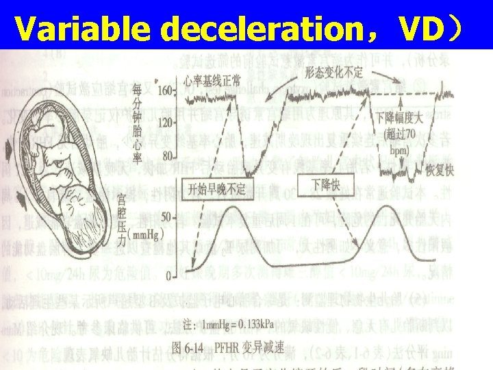 Variable deceleration，VD） 