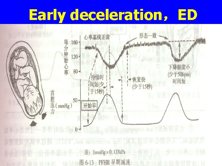 Early deceleration，ED 