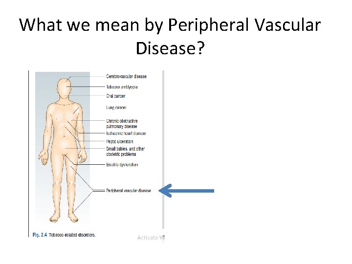 What we mean by Peripheral Vascular Disease? 