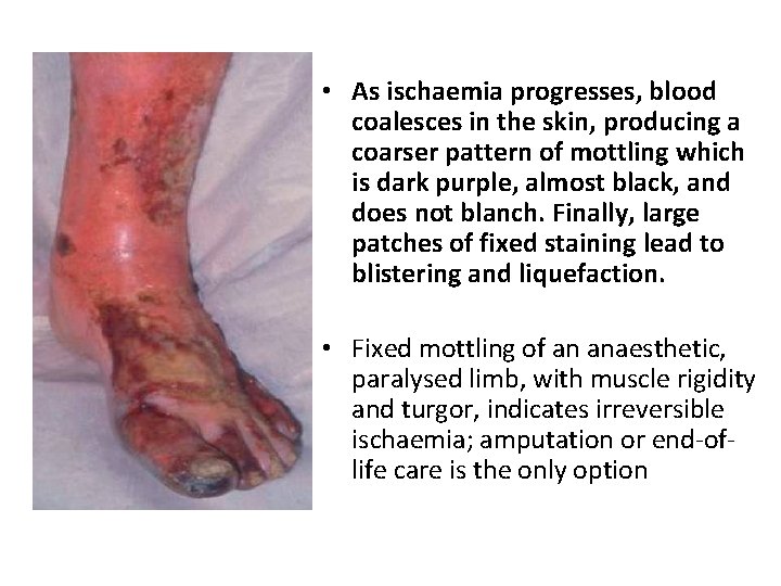  • As ischaemia progresses, blood coalesces in the skin, producing a coarser pattern