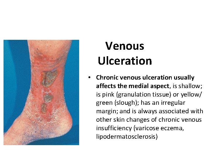 Venous Ulceration • Chronic venous ulceration usually affects the medial aspect, is shallow; is