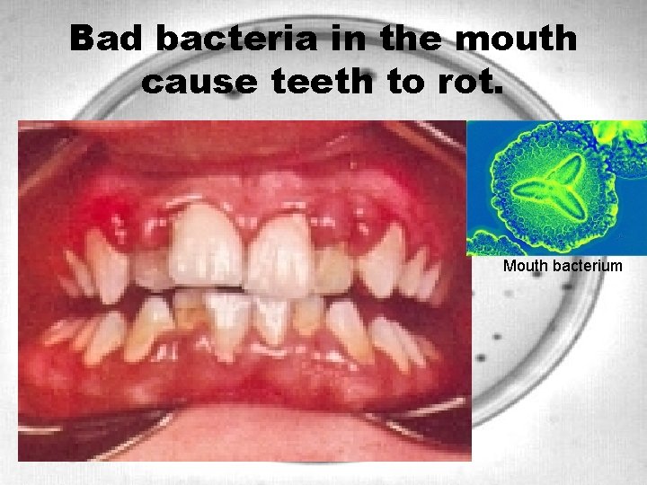 Bad bacteria in the mouth cause teeth to rot. Mouth bacteria Mouth bacterium 