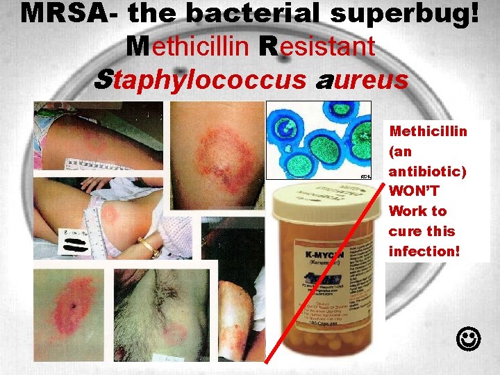 MRSA- the bacterial superbug! Methicillin Resistant Staphylococcus aureus Methicillin (an antibiotic) WON’T Work to