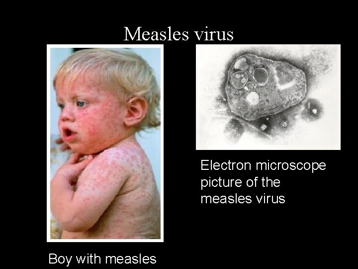 Measles virus Electron microscope picture of the measles virus Boy with measles 