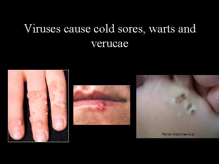 Viruses cause cold sores, warts and verucae 