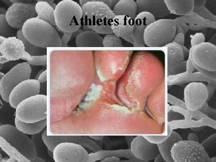 Athletes foot 