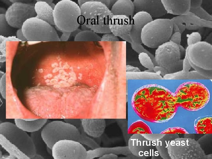 Oral thrush Thrush yeast cells 