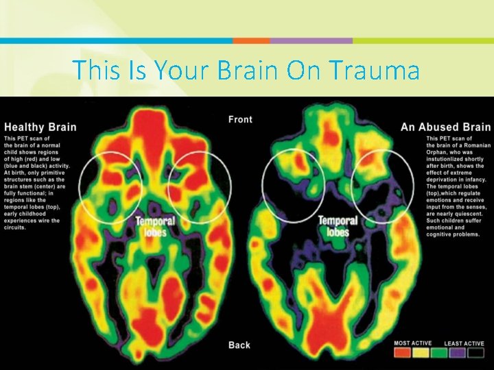 This Is Your Brain On Trauma 