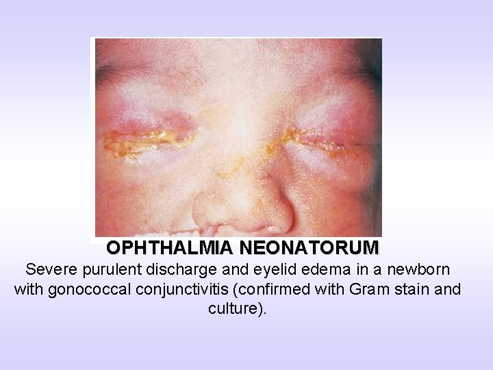 OPHTHALMIA NEONATORUM Severe purulent discharge and eyelid edema in a newborn with gonococcal conjunctivitis