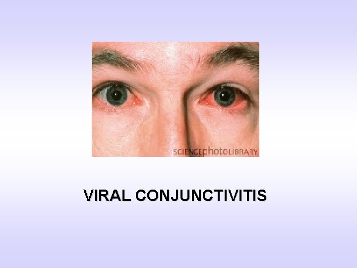 VIRAL CONJUNCTIVITIS 