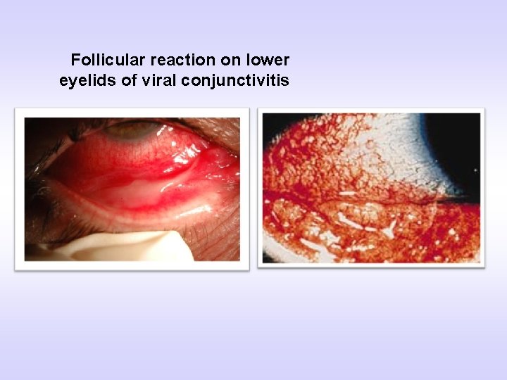 Follicular reaction on lower eyelids of viral conjunctivitis 