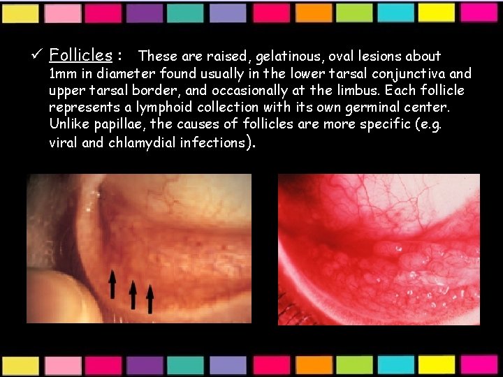 ü Follicles : These are raised, gelatinous, oval lesions about 1 mm in diameter