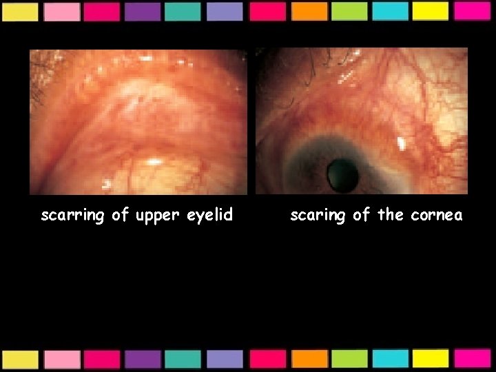 the upper lidkjifgb • scarring of upper eyelid scaring of the cornea 