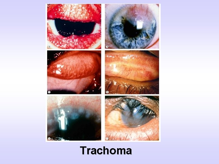 Trachoma 