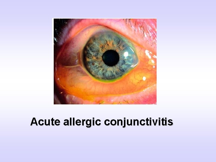 Acute allergic conjunctivitis 