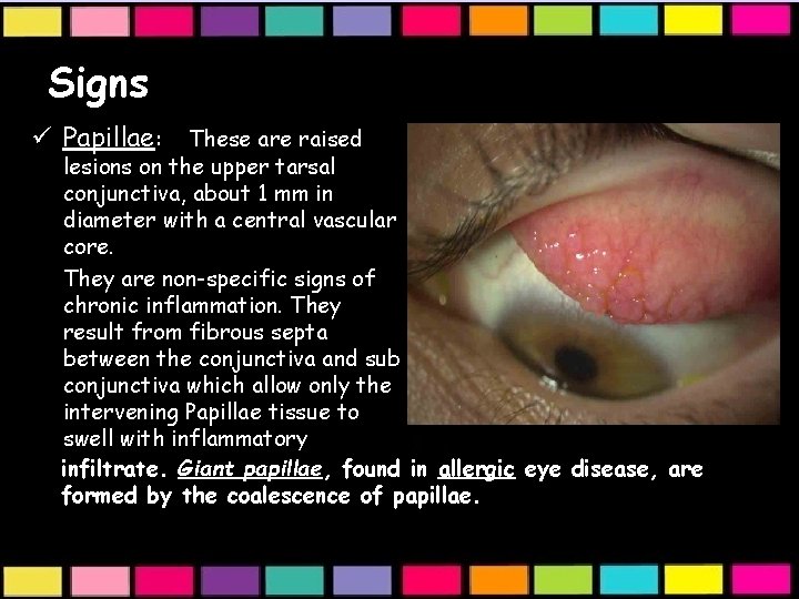 Signs ü Papillae: These are raised lesions on the upper tarsal conjunctiva, about 1