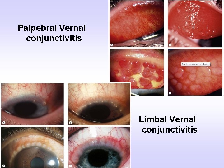 Palpebral Vernal conjunctivitis Limbal Vernal conjunctivitis 