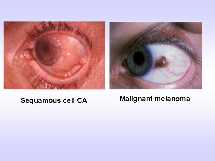 Sequamous cell CA Malignant melanoma 