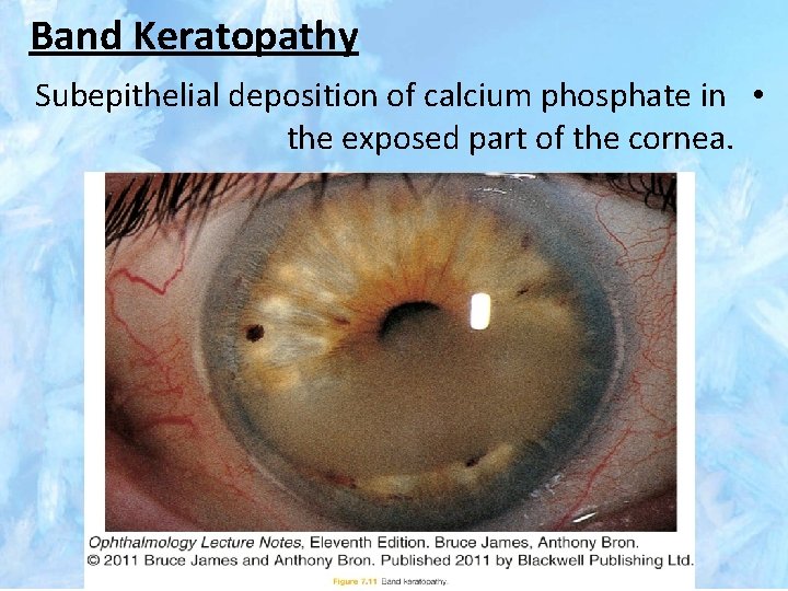 Band Keratopathy Subepithelial deposition of calcium phosphate in • the exposed part of the