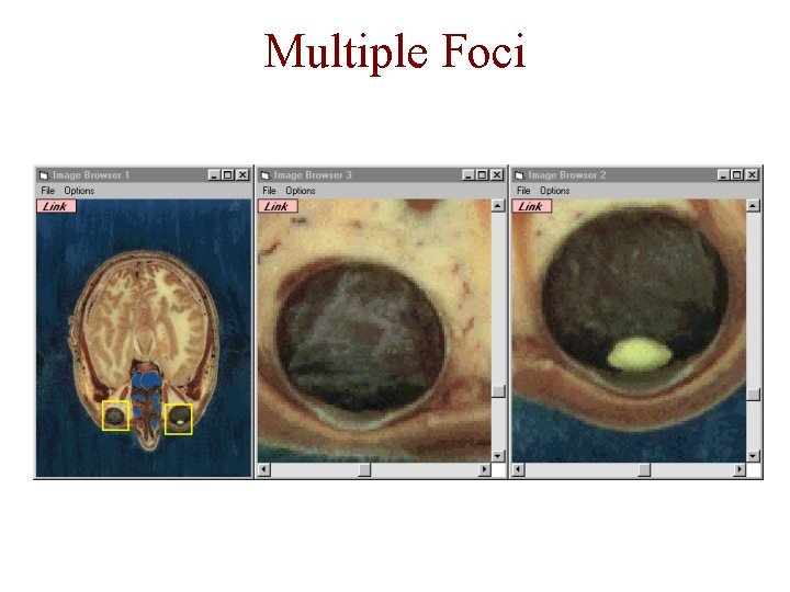 Multiple Foci 