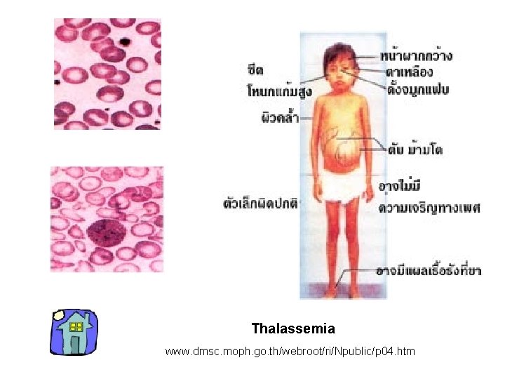 Thalassemia www. dmsc. moph. go. th/webroot/ri/Npublic/p 04. htm 