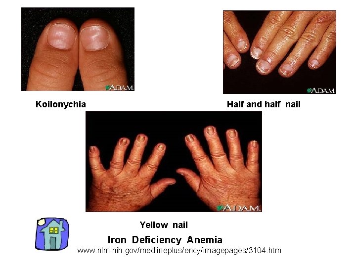 Half and half nail Koilonychia Yellow nail Iron Deficiency Anemia www. nlm. nih. gov/medlineplus/ency/imagepages/3104.