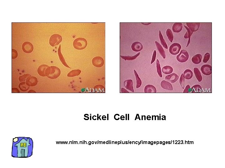 Sickel Cell Anemia www. nlm. nih. gov/medlineplus/ency/imagepages/1223. htm 