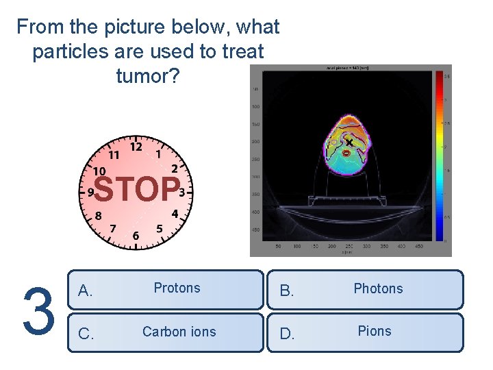 From the picture below, what particles are used to treat tumor? STOP 3 A.