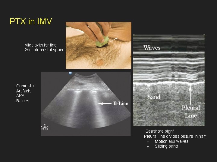 PTX in IMV Midclavicular line 2 nd intercostal space Comet-tail Artifacts AKA B-lines “Seashore