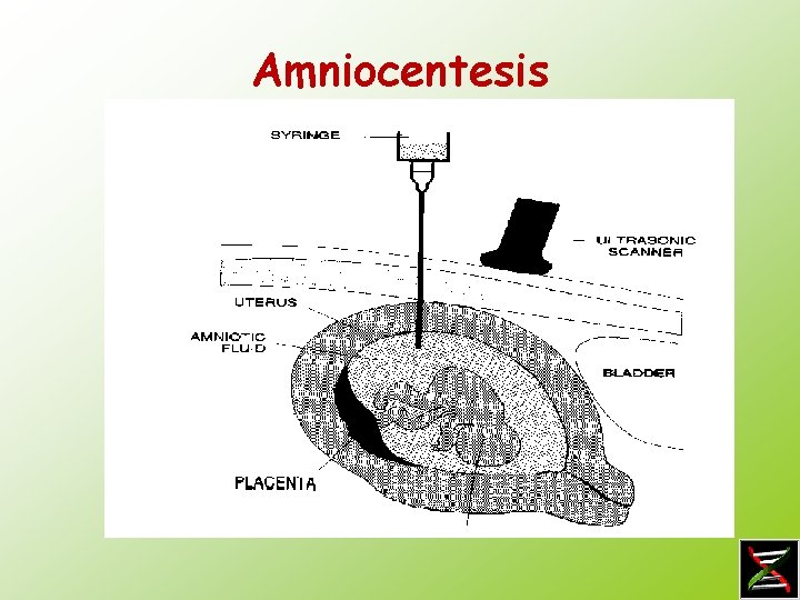 Amniocentesis 