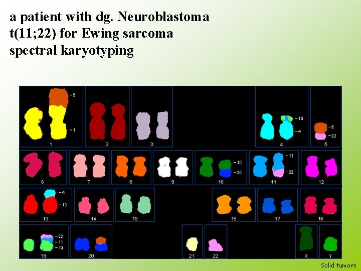 a patient with dg. Neuroblastoma t(11; 22) for Ewing sarcoma spectral karyotyping 149 Solid
