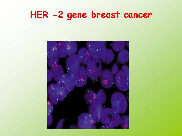 HER -2 gene breast cancer 