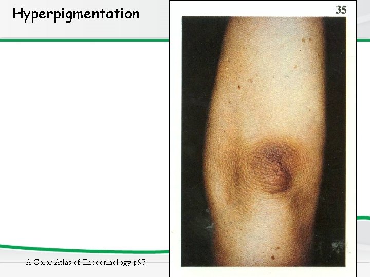 Hyperpigmentation A Color Atlas of Endocrinology p 97 