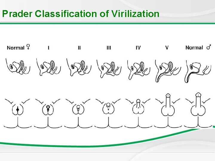 Prader Classification of Virilization 