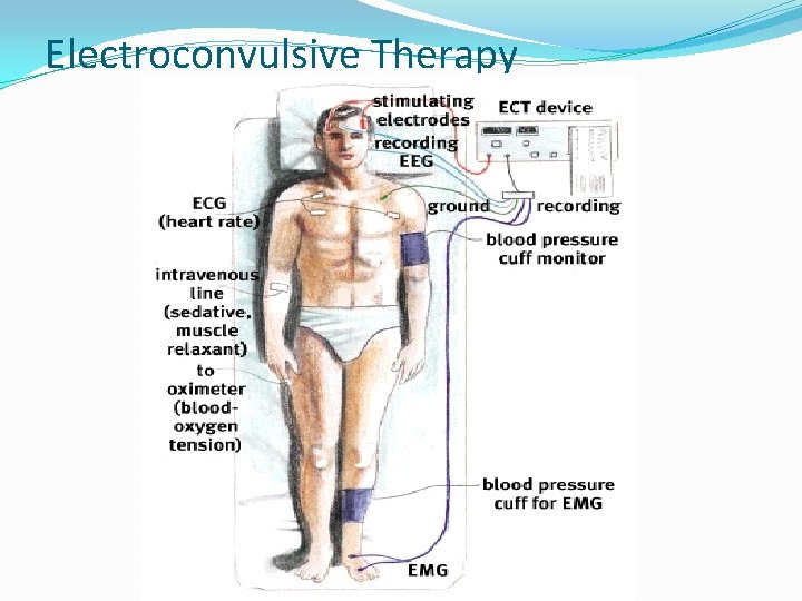 Electroconvulsive Therapy 