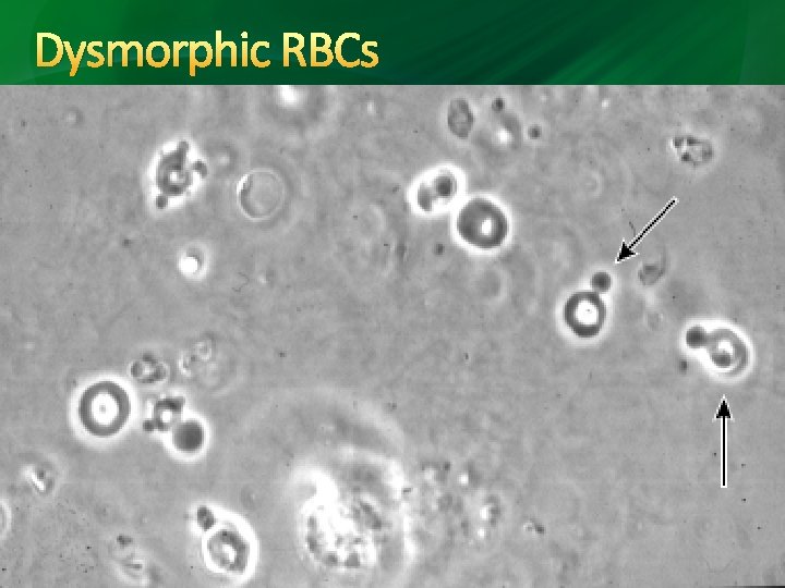 Dysmorphic RBCs Dysmorphic RBCs