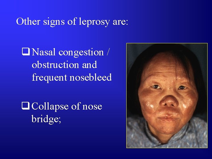 Other signs of leprosy are: q Nasal congestion / obstruction and frequent nosebleed q