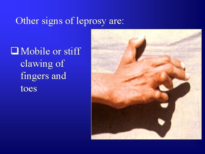 Other signs of leprosy are: q Mobile or stiff clawing of fingers and toes