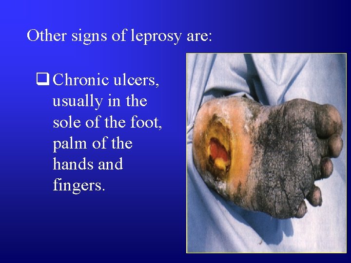 Other signs of leprosy are: q Chronic ulcers, usually in the sole of the