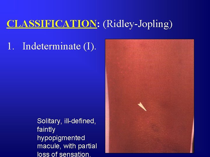CLASSIFICATION: (Ridley-Jopling) 1. Indeterminate (I). Solitary, ill-defined, faintly hypopigmented macule, with partial loss of