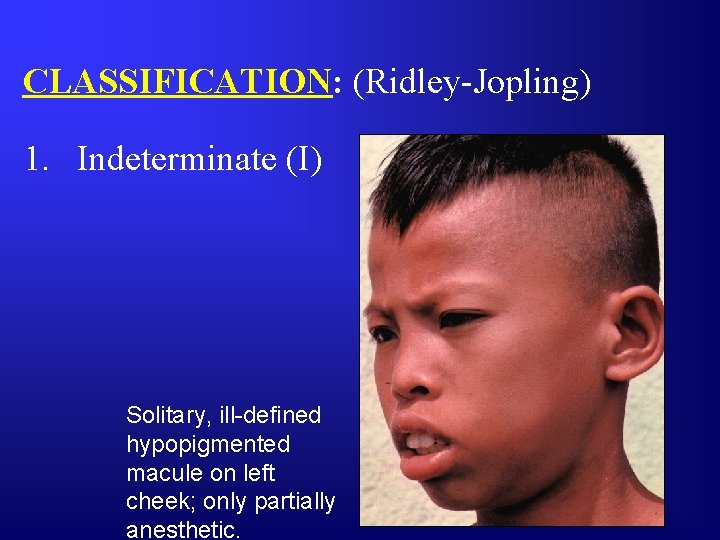 CLASSIFICATION: (Ridley-Jopling) 1. Indeterminate (I) Solitary, ill-defined hypopigmented macule on left cheek; only partially