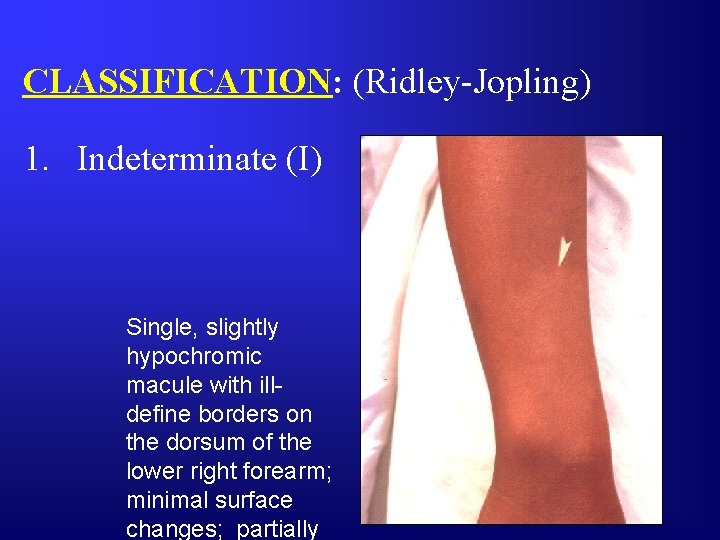 CLASSIFICATION: (Ridley-Jopling) 1. Indeterminate (I) Single, slightly hypochromic macule with illdefine borders on the