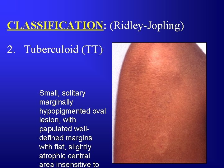 CLASSIFICATION: (Ridley-Jopling) 2. Tuberculoid (TT) Small, solitary marginally hypopigmented oval lesion, with papulated welldefined