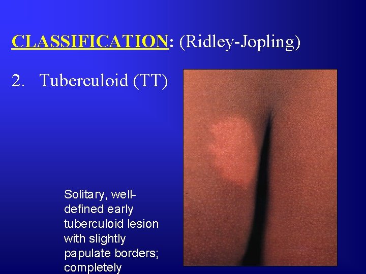 CLASSIFICATION: (Ridley-Jopling) 2. Tuberculoid (TT) Solitary, welldefined early tuberculoid lesion with slightly papulate borders;