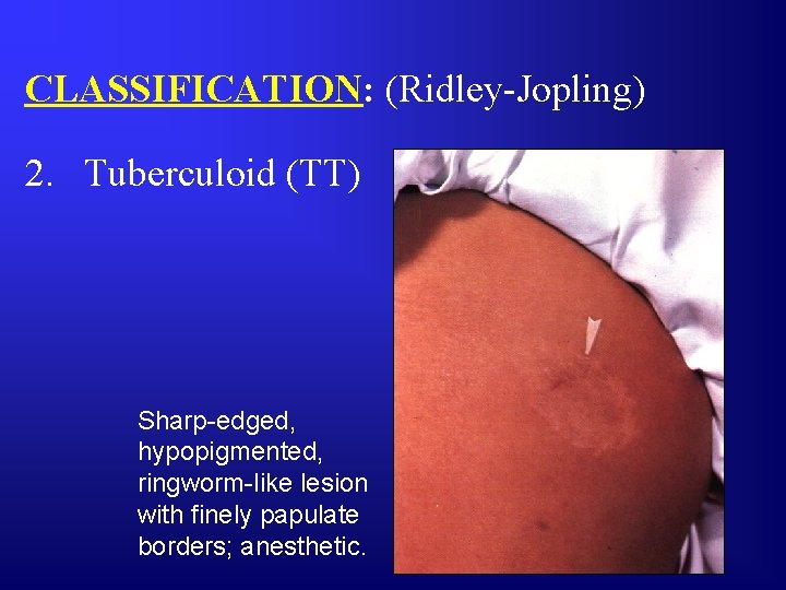 CLASSIFICATION: (Ridley-Jopling) 2. Tuberculoid (TT) Sharp-edged, hypopigmented, ringworm-like lesion with finely papulate borders; anesthetic.