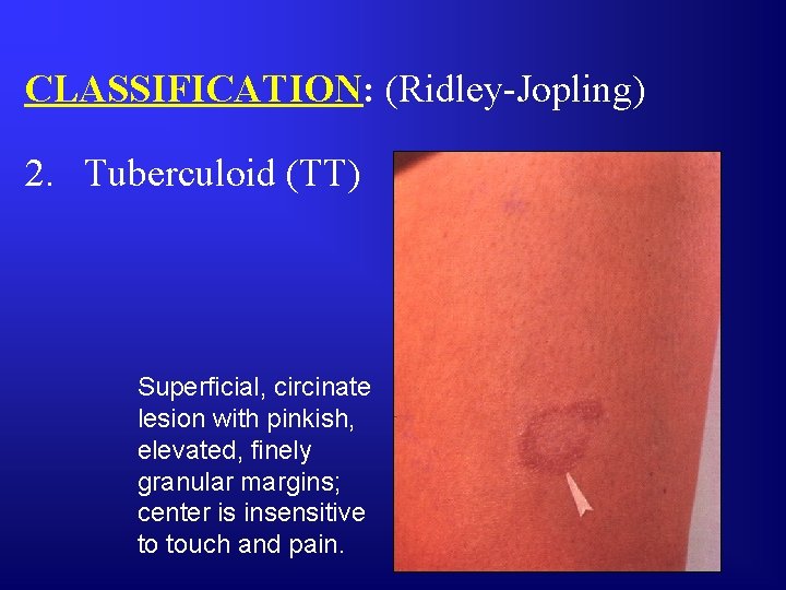 CLASSIFICATION: (Ridley-Jopling) 2. Tuberculoid (TT) Superficial, circinate lesion with pinkish, elevated, finely granular margins;