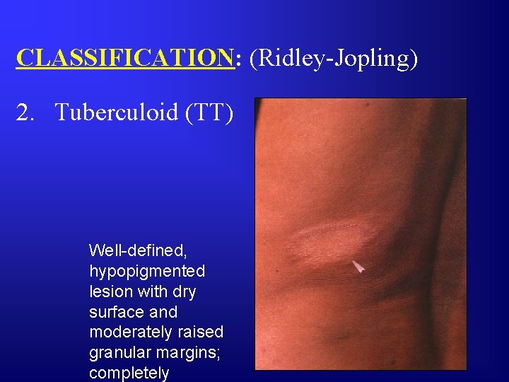 CLASSIFICATION: (Ridley-Jopling) 2. Tuberculoid (TT) Well-defined, hypopigmented lesion with dry surface and moderately raised