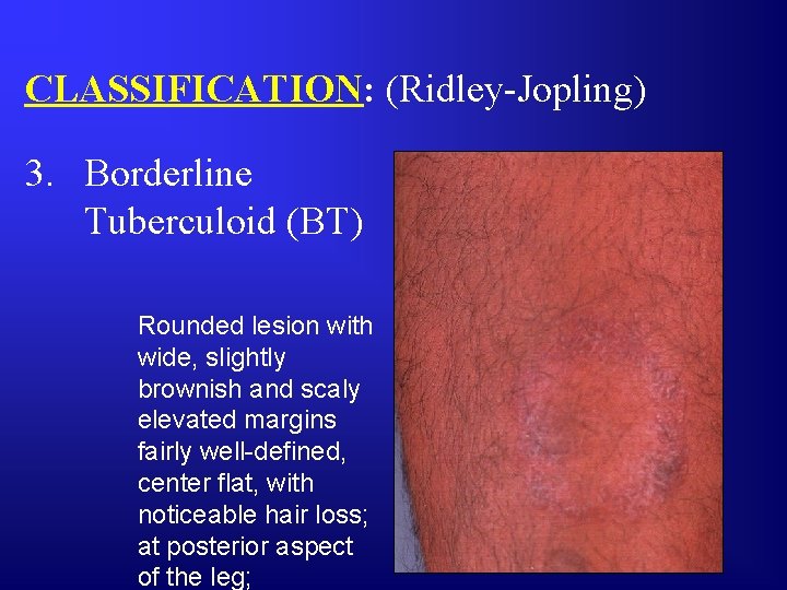 CLASSIFICATION: (Ridley-Jopling) 3. Borderline Tuberculoid (BT) Rounded lesion with wide, slightly brownish and scaly