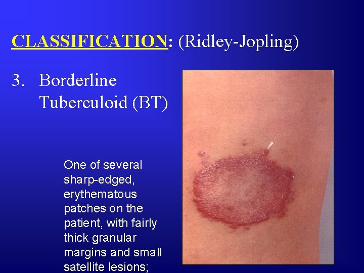 CLASSIFICATION: (Ridley-Jopling) 3. Borderline Tuberculoid (BT) One of several sharp-edged, erythematous patches on the
